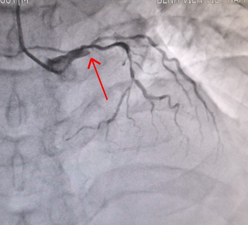 nhoi mau co tim anh 1