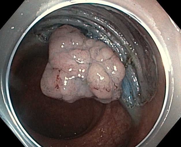 khoi u truc trang anh 1