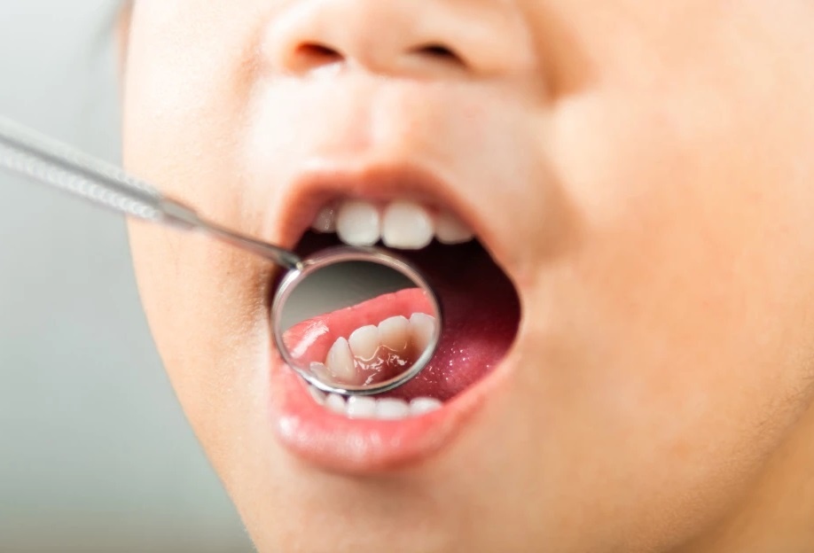 Thoi diem tot nhat de nieng rang cho tre hinh anh