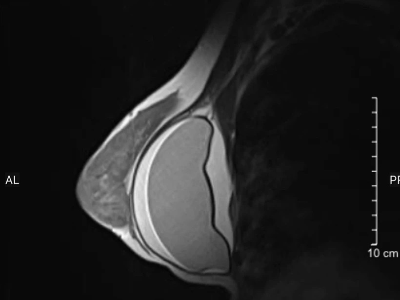 vo tui don nguc anh 1