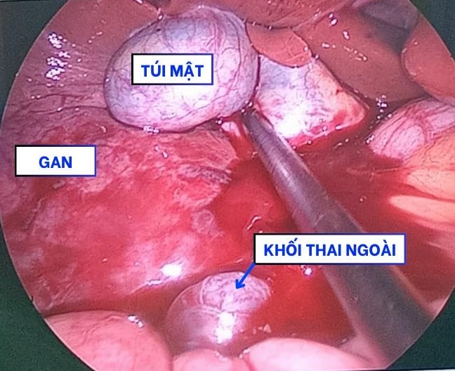thai ngoai tu cung anh 1