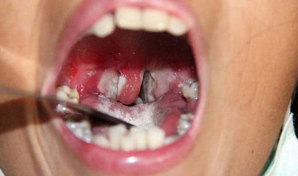 Cham soc tre bi benh bach hau hinh anh