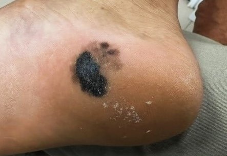 Phat hien ung thu ac tinh tu dom den o got chan hinh anh