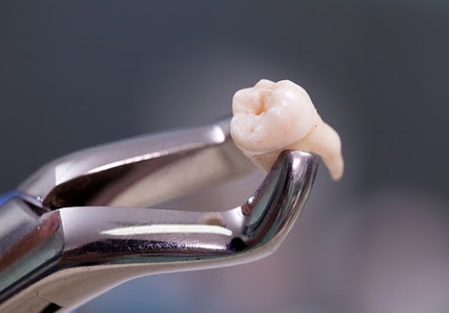 Phai di cap cuu chi vi nho rang khon hinh anh