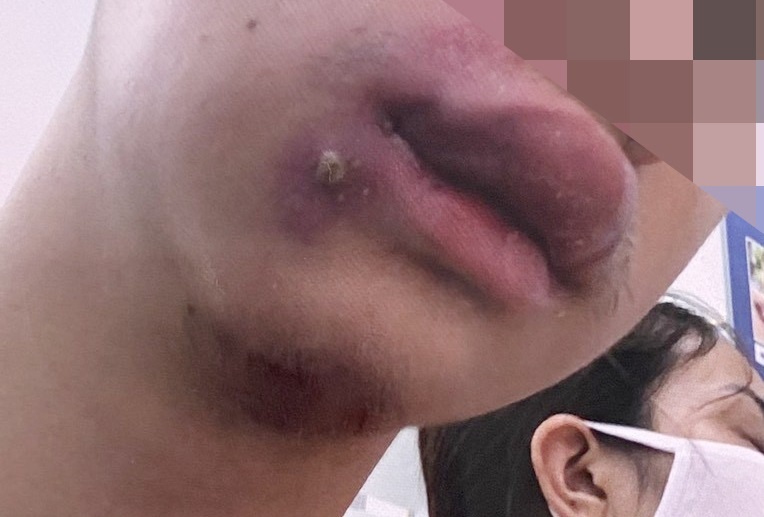 nhap vien vi nan mun anh 1