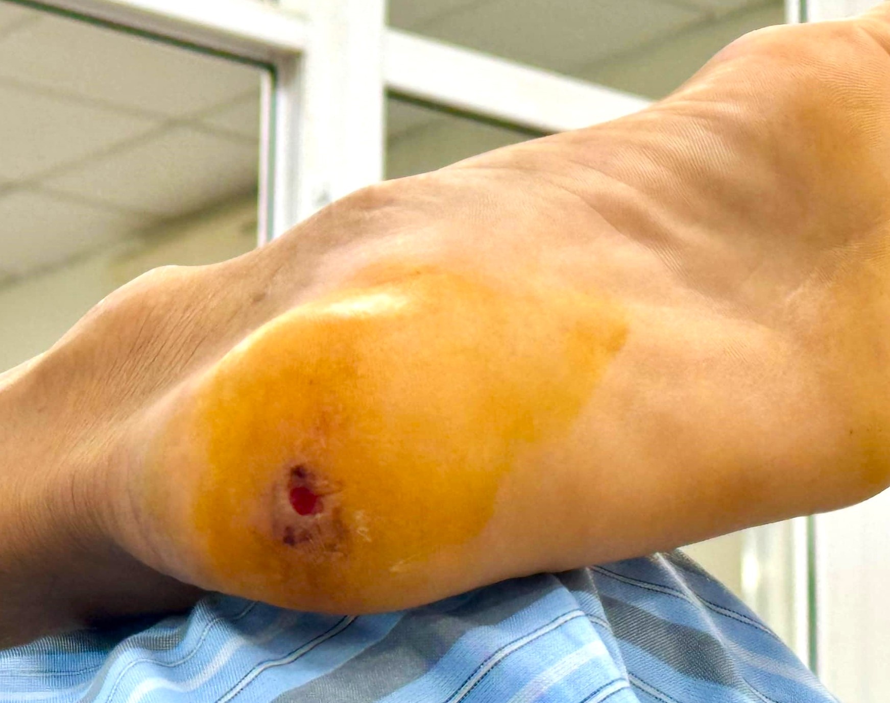 Nguy kich chi vi giam phai chiec gai nhon hinh anh