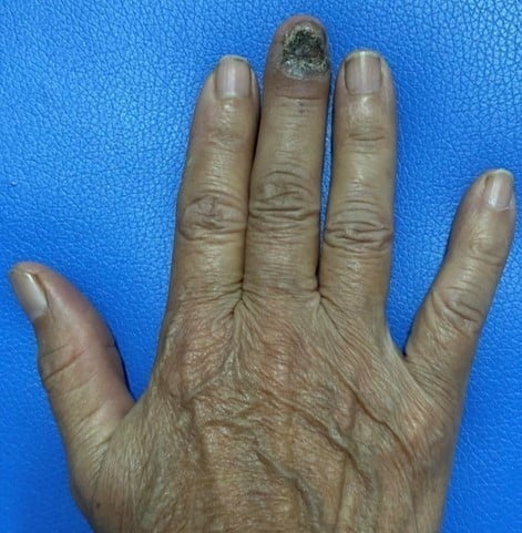dau hieu ung thu da anh 2