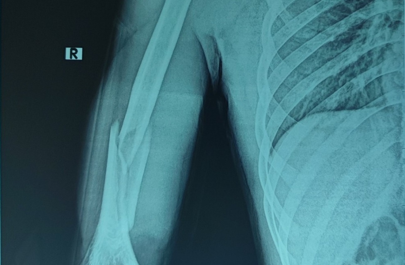 Nhap vien cap cuu sau khi choi vat tay cung ban hinh anh