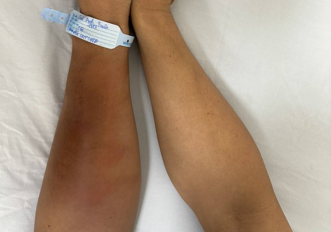 Suyt phai cat bo tay vi nhiem vi khuan 'an thit nguoi' hinh anh