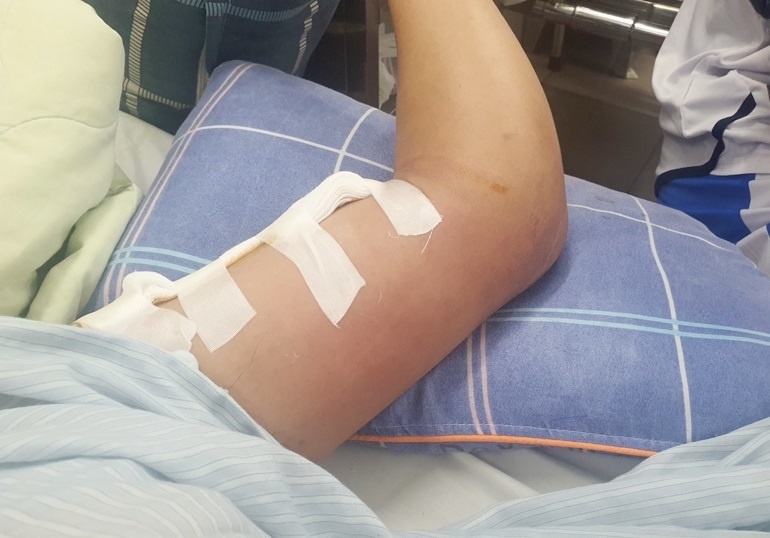 Lien tiep nhieu nguoi nhiem vi khuan Whitmore nhap vien hinh anh