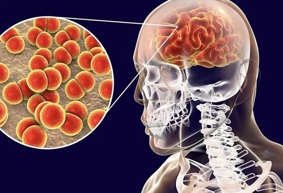 6 benh viem mang nao, viem nao thuong gap hinh anh