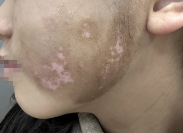 Nguyen nhan, trieu chung, cach dieu tri benh bach bien hinh anh