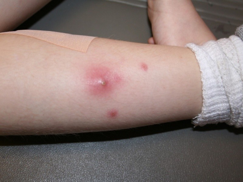 Dau hieu mun nhot bi nhiem trung hinh anh