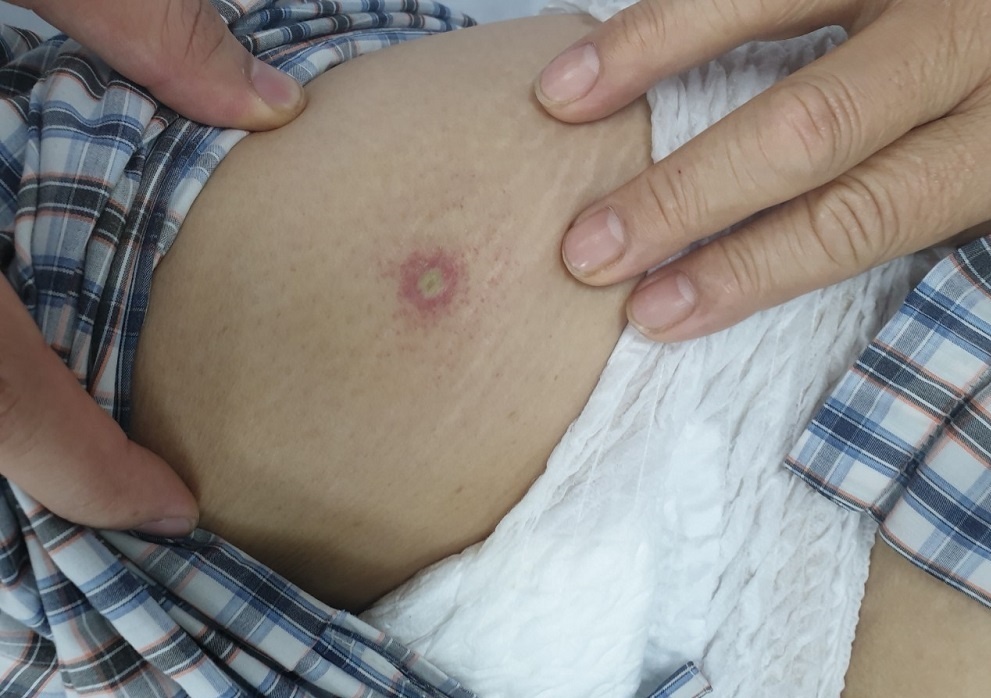 Cach xu ly khi bi con trung dot hinh anh