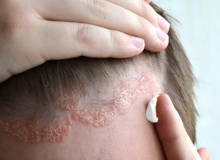 Nam da dau co lay khong? hinh anh