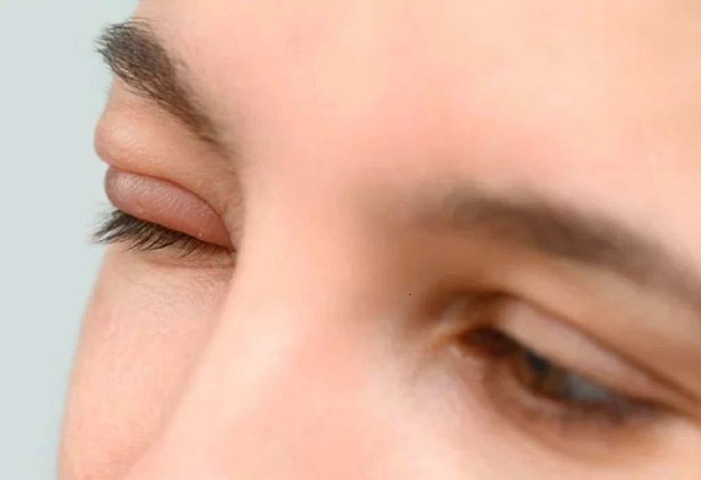 Lam gi khi mat bi leo? hinh anh