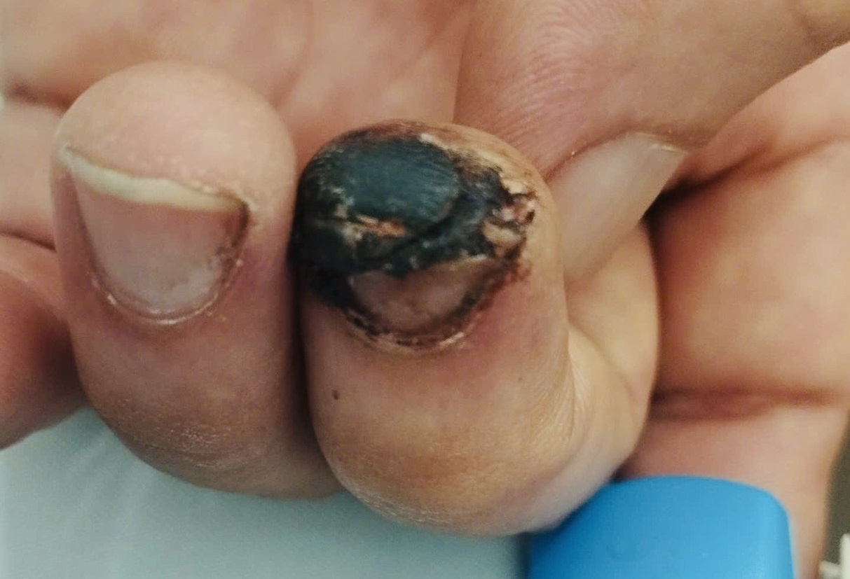 Nguy kich chi vi giam phai vat nhon tren duong hinh anh