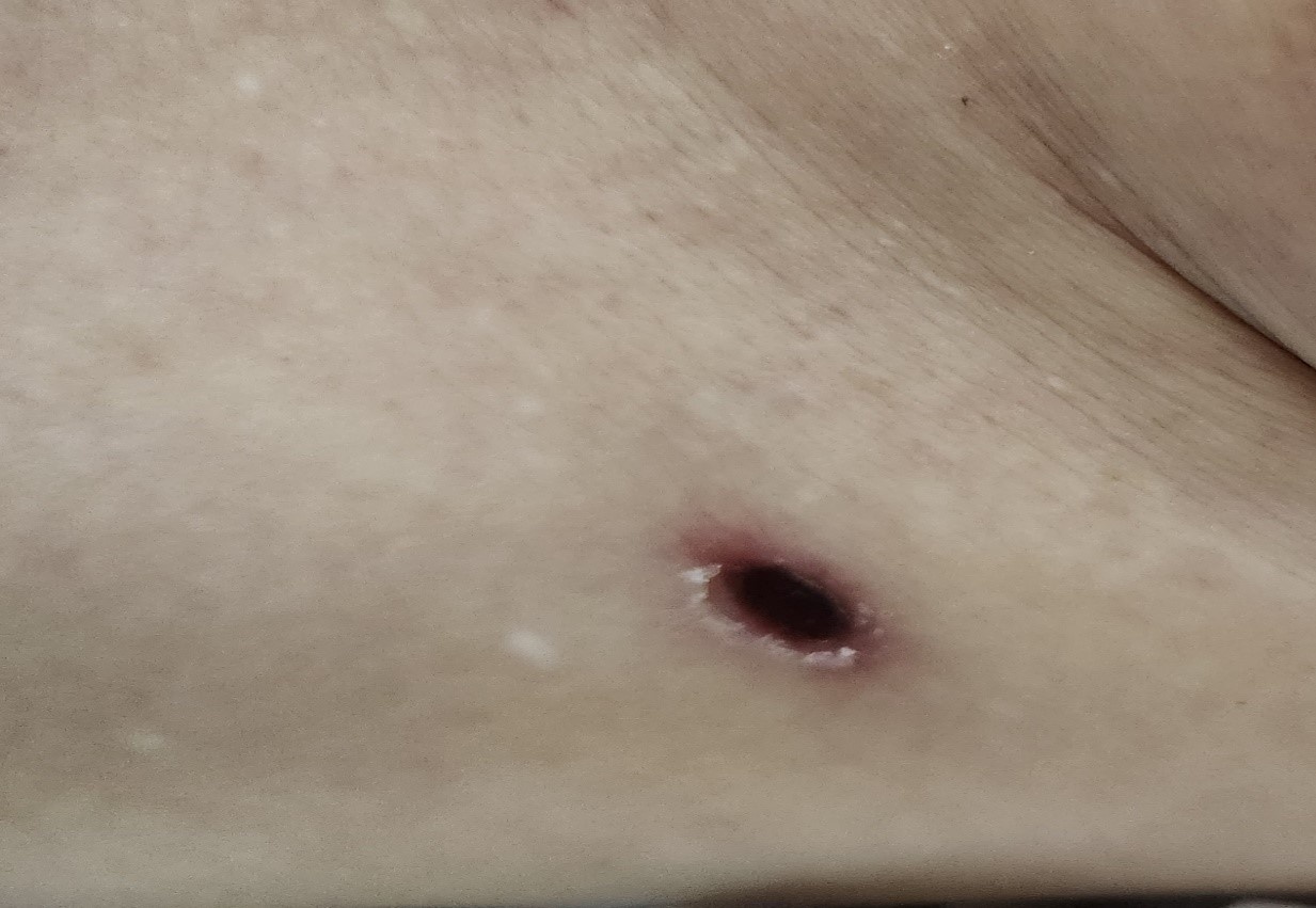 Suy da tang chi vi vet loet nho tren da hinh anh