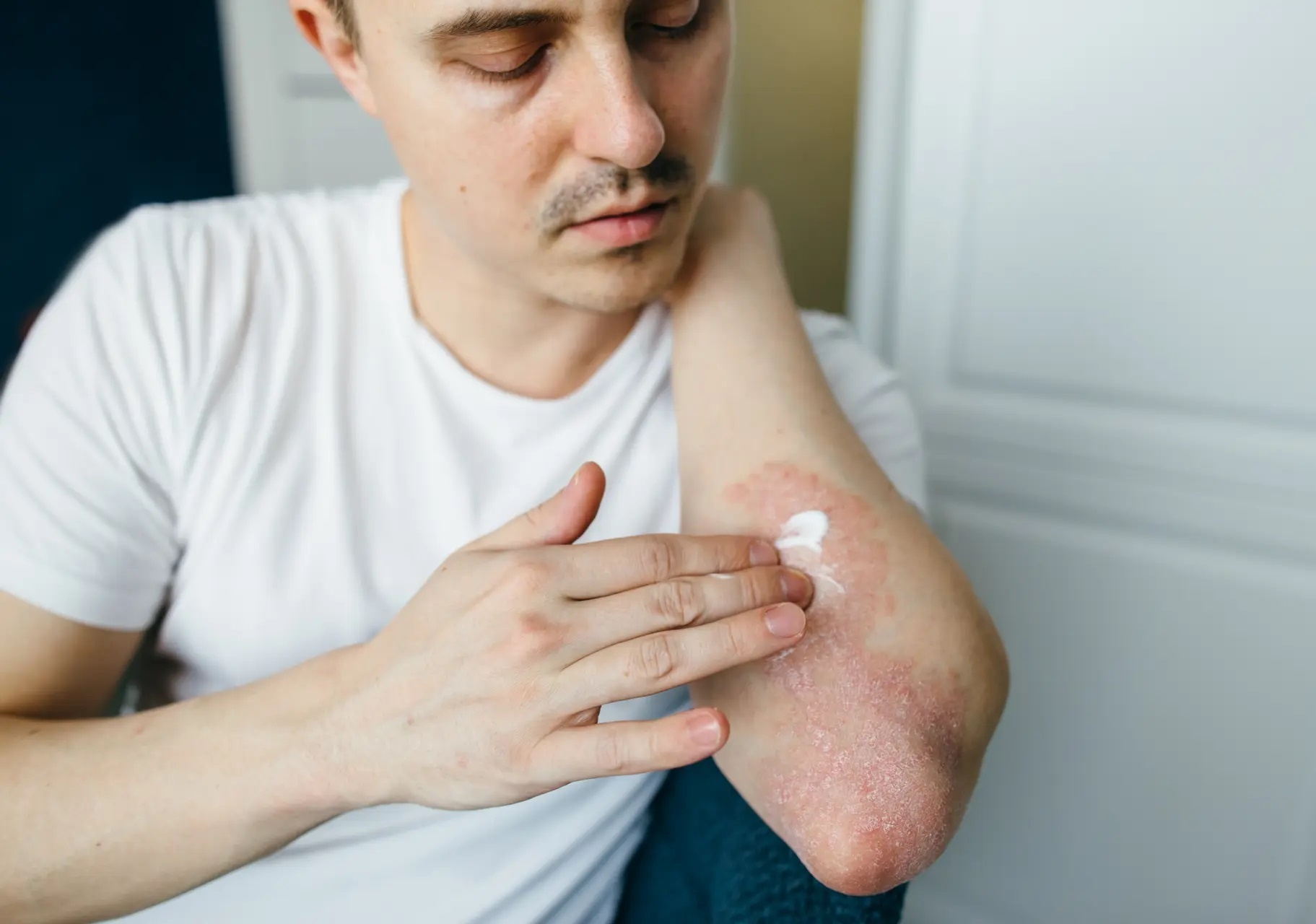 Viem da co dia dung thuoc nhu the nao? hinh anh