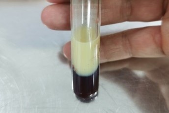 Mot bien chung nguy hiem cua mo mau hinh anh