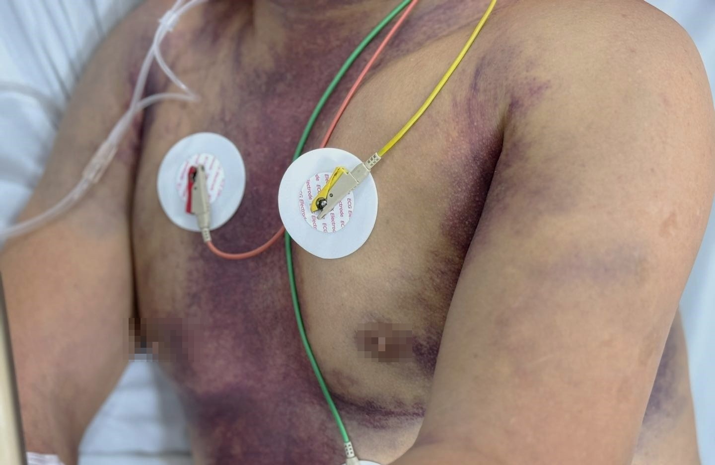 Mat mot nua luong mau trong co the vi sot xuat huyet hinh anh