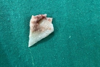 Be gai phai cap cuu noi soi vi su co khi an chao hinh anh