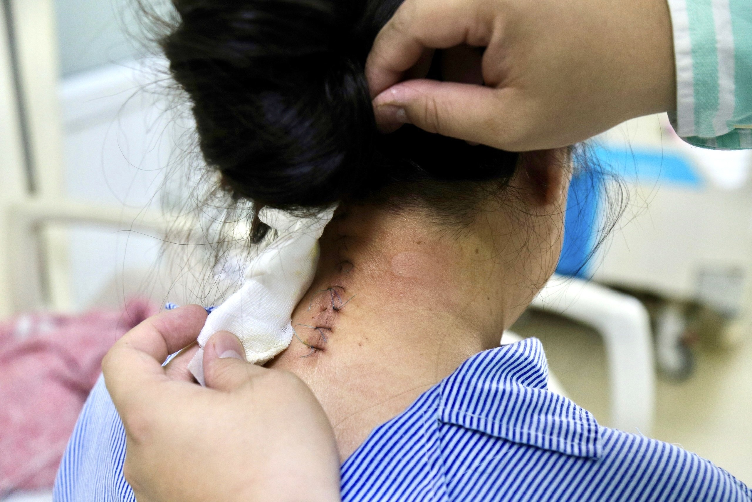 Dau co, te bi mot nam khong khoi, nguoi phu nu phat hien benh hiem hinh anh