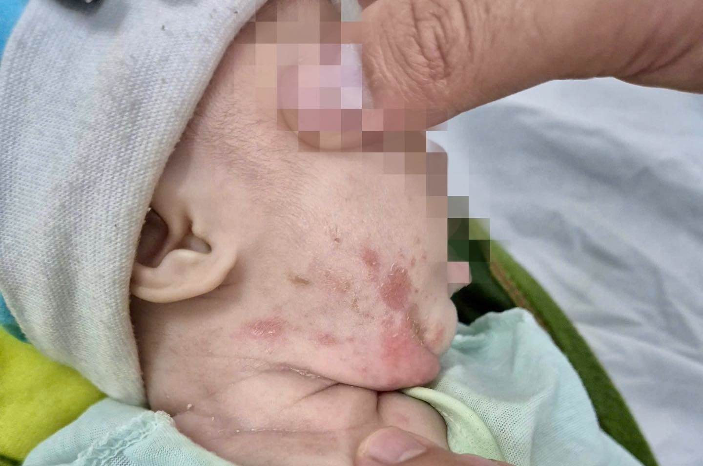 Bo me khong biet mac giang mai, con gai sinh ra nhiem benh hinh anh