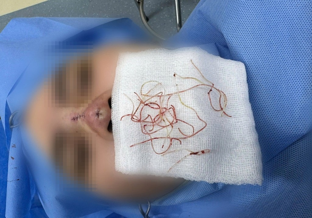 Bac si gap tung soi chi de giai cuu chiec mui cho co gai tre hinh anh