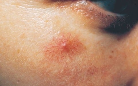 3 dau hieu benh gan bieu hien ngay tren mat hinh anh