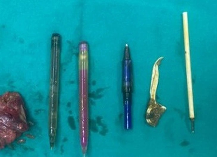 Bac si ngac nhien khi lay ra nhieu thu ky di trong bung benh nhan hinh anh