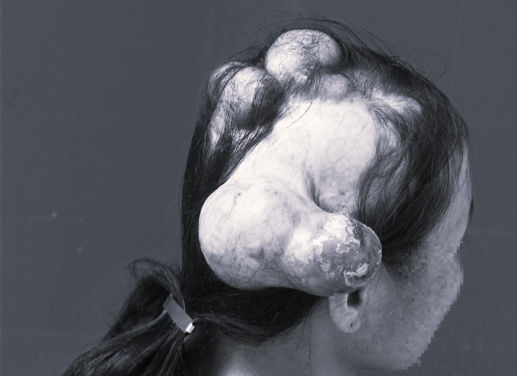 Benh ung thu khien nguoi phu nu 'moc sung' chi chit tren dau hinh anh