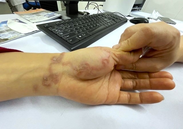 San bo lom ngom duoi da nguoi phu nu nuoi cho hinh anh