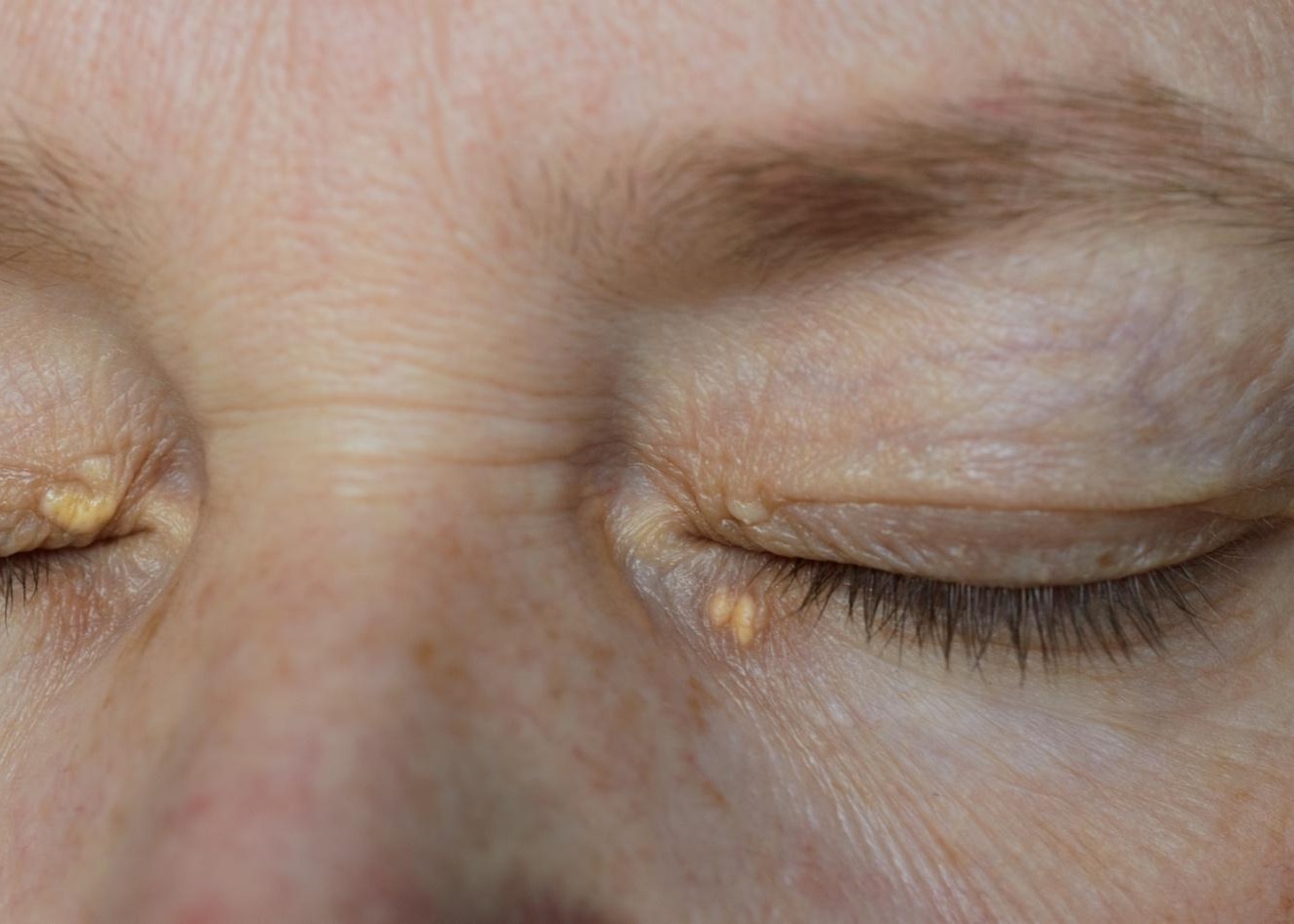 Nguoi co dau hieu nay nguy co cao bi mo mau cao hinh anh