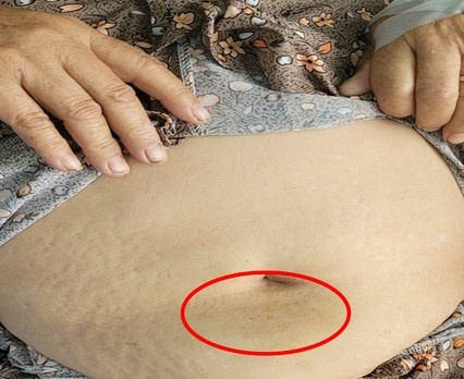 Hiem hoa chet nguoi khi tiem insulin sai cach hinh anh