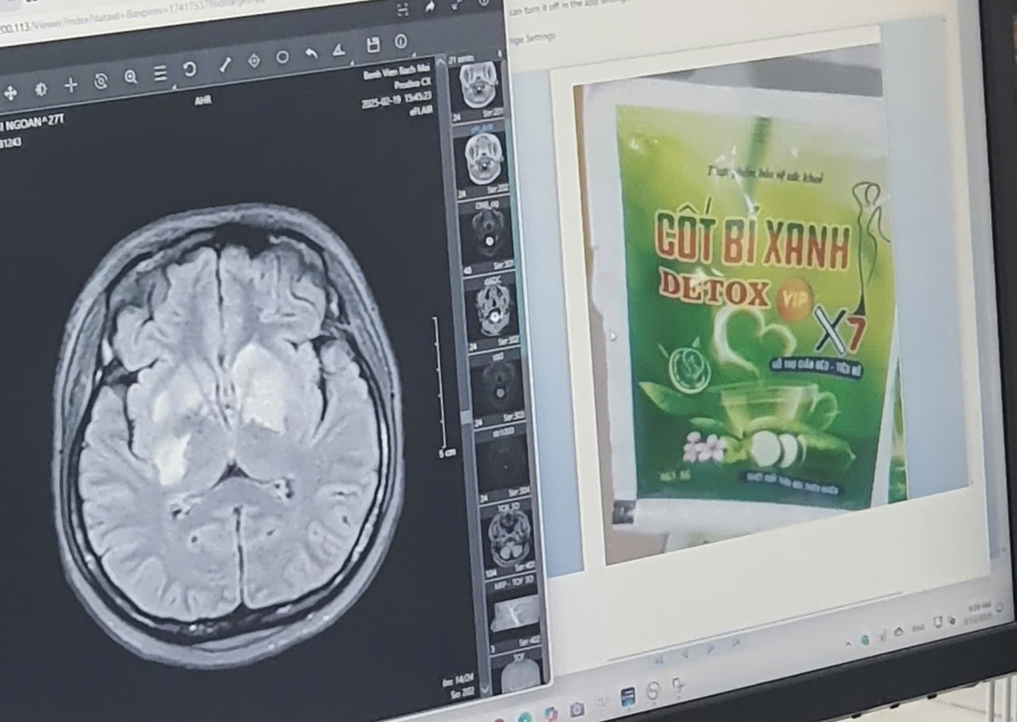 Co gai 27 tuoi suy than, mu mat vi cach giam can sai lam hinh anh