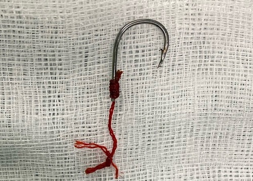 Luoi cau cam sau vao hau mon nguoi dan ong sau khi an ca hinh anh