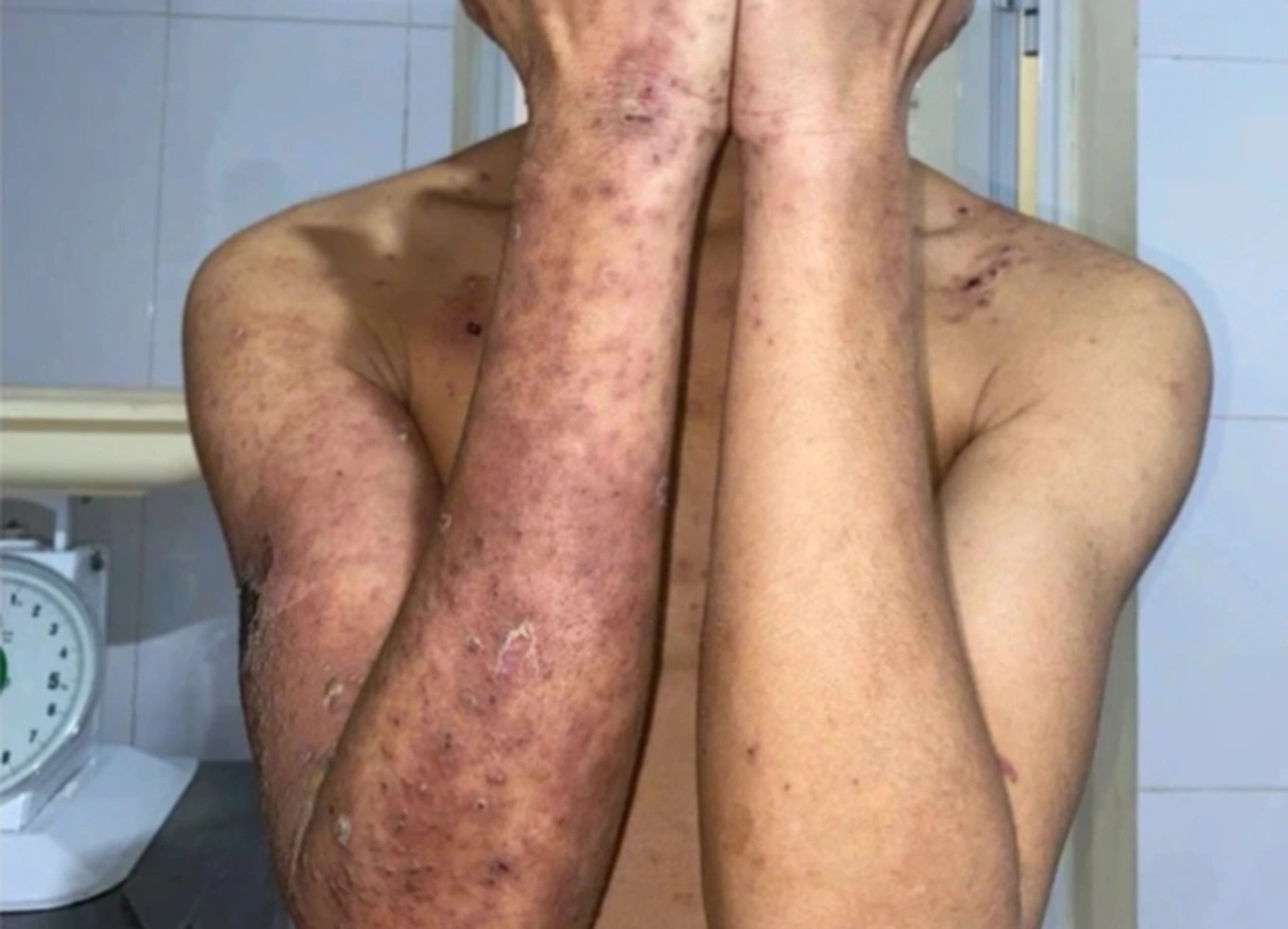 Ganh hau qua vi lieu linh dap kien ba khoang chua ngua hinh anh