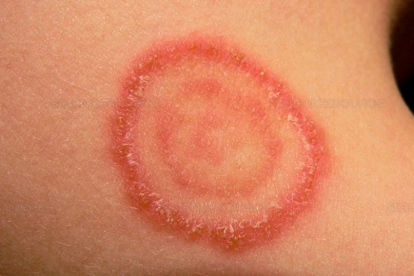 Lao da va mo duoi da: Nguyen nhan, bieu hien, cach dieu tri hinh anh