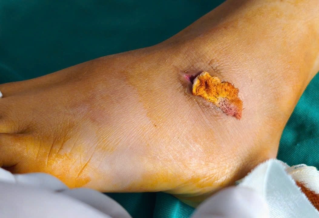 Nguy kich vi mot vet thuong nho o chan hinh anh