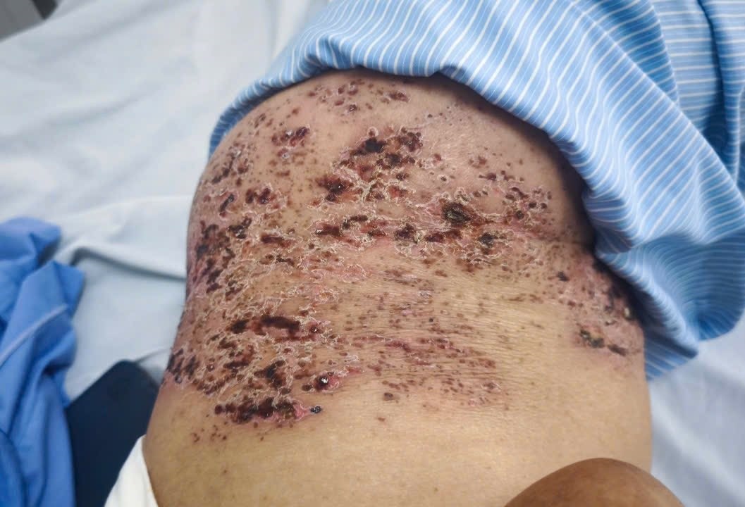 Zona than kinh gay dau don ra sao? hinh anh