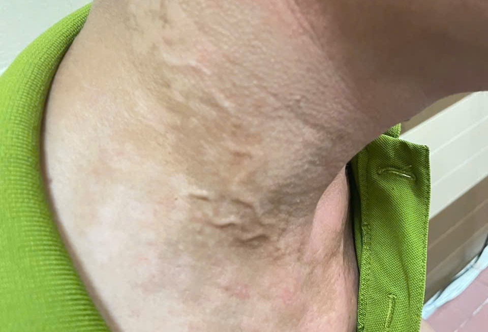 Giun noi ngoan ngoeo duoi da nguoi dan ong hinh anh