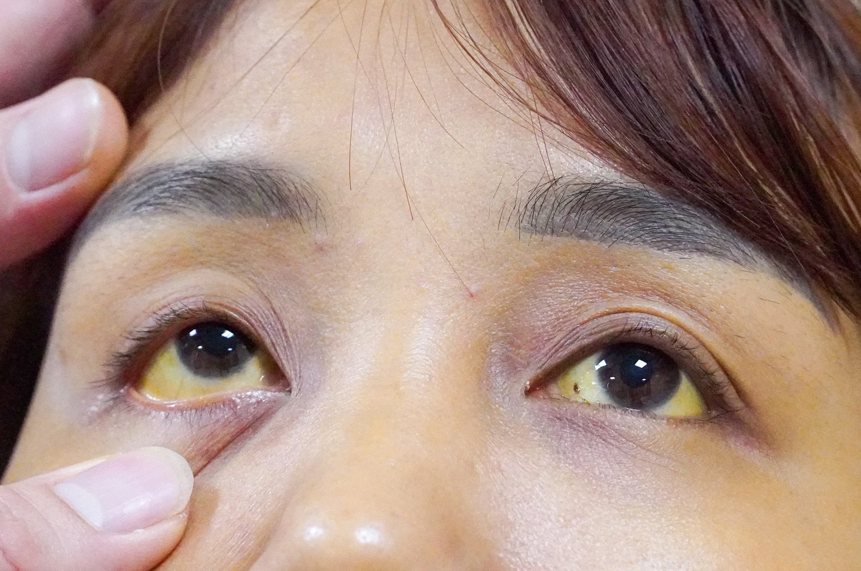 Gan bi huy hoai vi nhiem virus HBV hinh anh