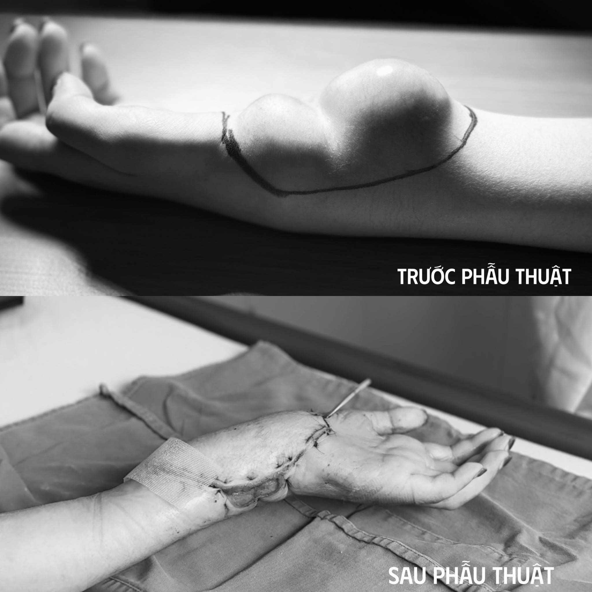 ung thu hiem gap anh 1