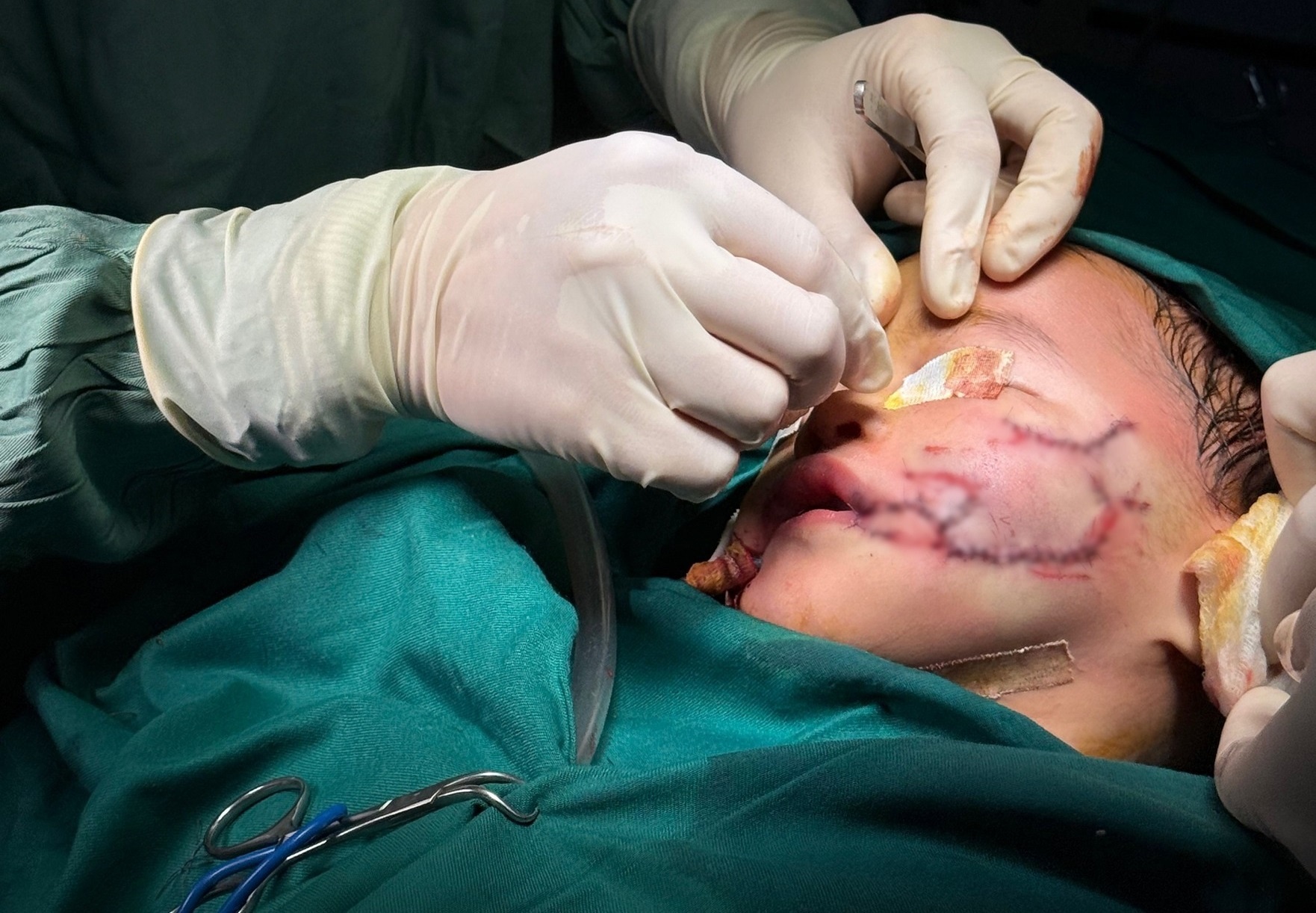 Be 2 tuoi bi cho nha nuoi can xe khap mat hinh anh