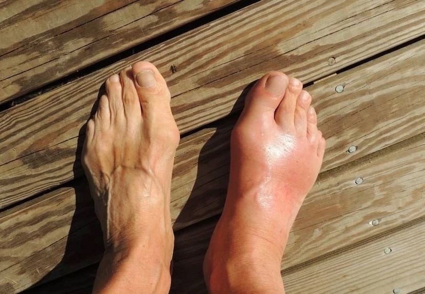 benh gout anh 1
