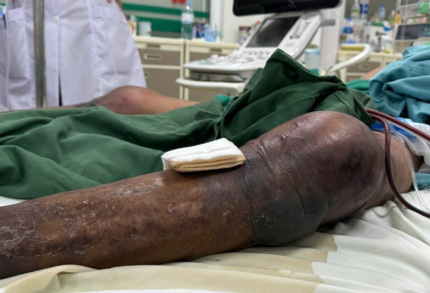 Tu vet gai dam, doi chan nguoi dan ong bi hoai tu, tim den hinh anh