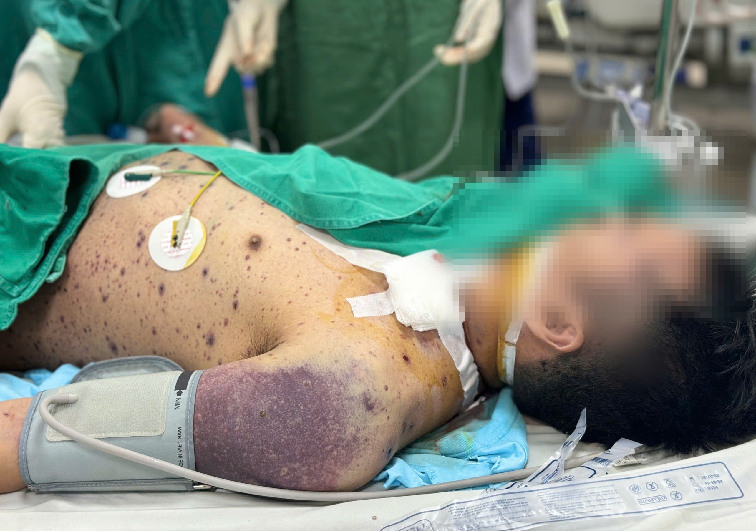 Can benh quen thuoc khien 2 nguoi khoe manh nguy kich sau vai ngay hinh anh