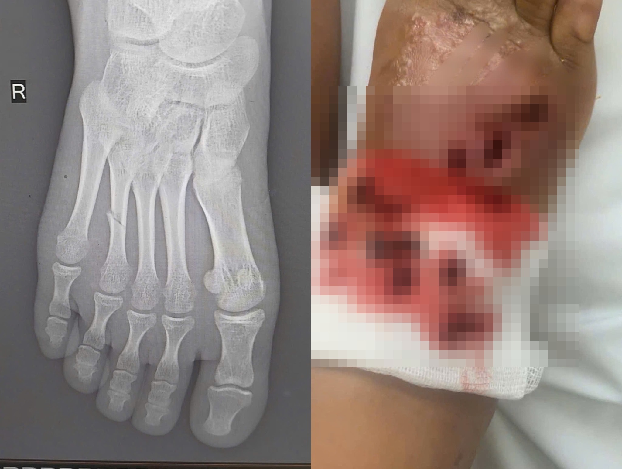 Be gai suyt mat chan vi bo thuoc nam chua gay xuong tai nha hinh anh