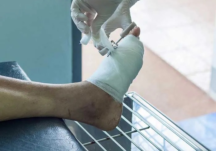 Mot sai lam nho khien cu ong nhap vien voi nguy co cat cut chan hinh anh